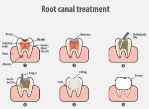 front tooth root canal