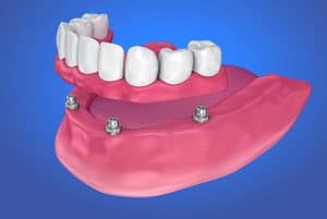 Implant Retained Lower Denture
